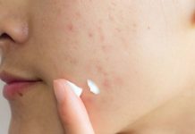 How to get rid of Acne Scars? How to get rid of Acne Scars?